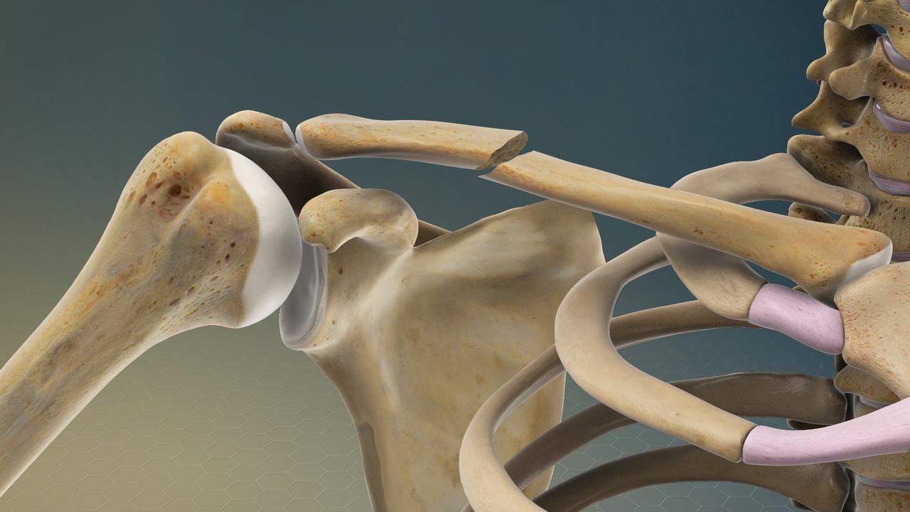 Biomechanics And Prevalence Of Clavicle Fractures - Mechanisms Of Injury And Anatomical Vulnerabilities